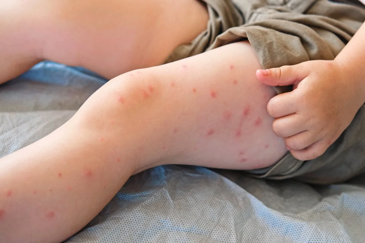 Estado de SP confirma mais dois casos de sarampo e total chega a 30